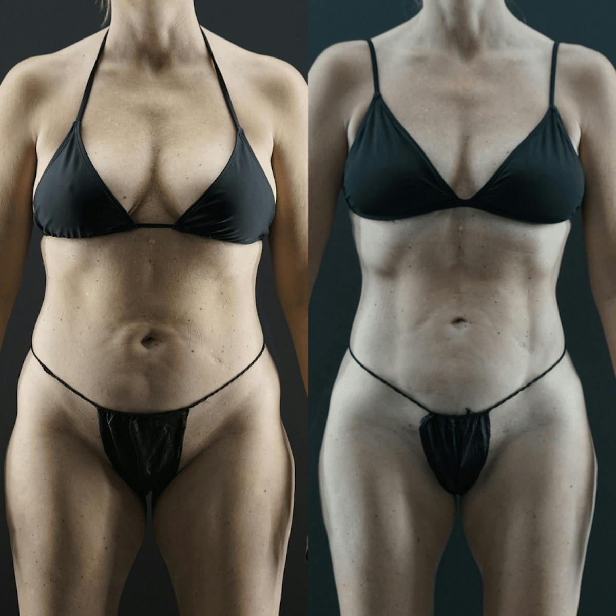 VASER/Hi-Definition Liposuction Before & After Gallery - Patient 139162 - Image 3
