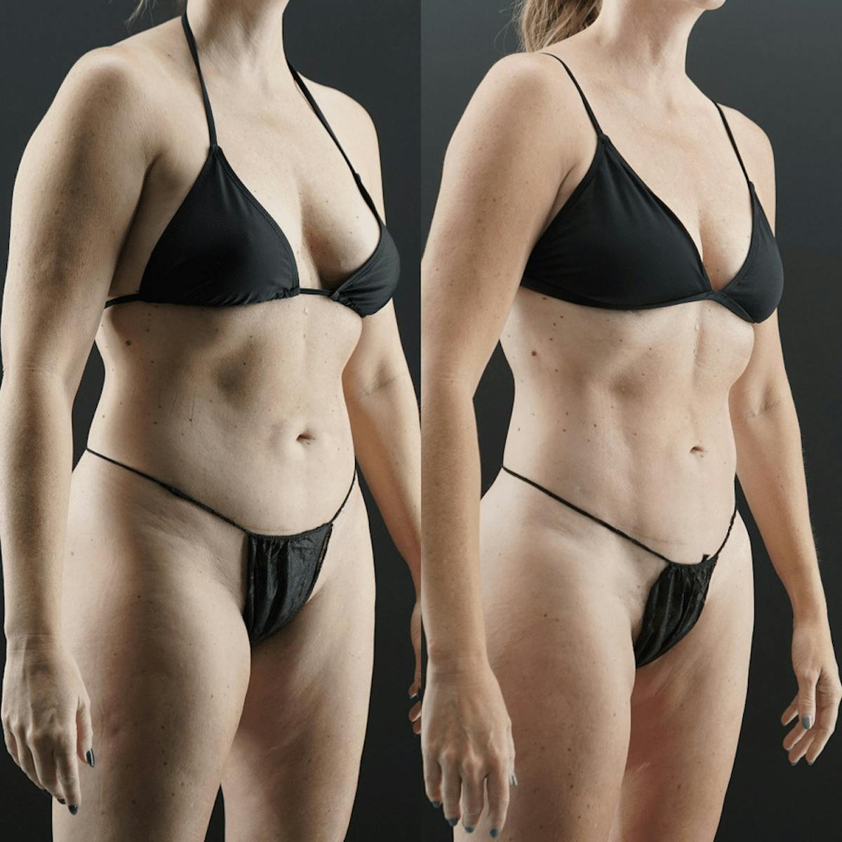 VASER/Hi-Definition Liposuction Before & After Gallery - Patient 139162 - Image 1