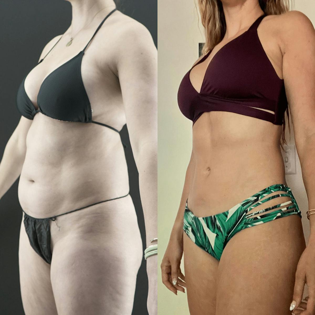 VASER/Hi-Definition Liposuction Before & After Gallery - Patient 349783 - Image 2