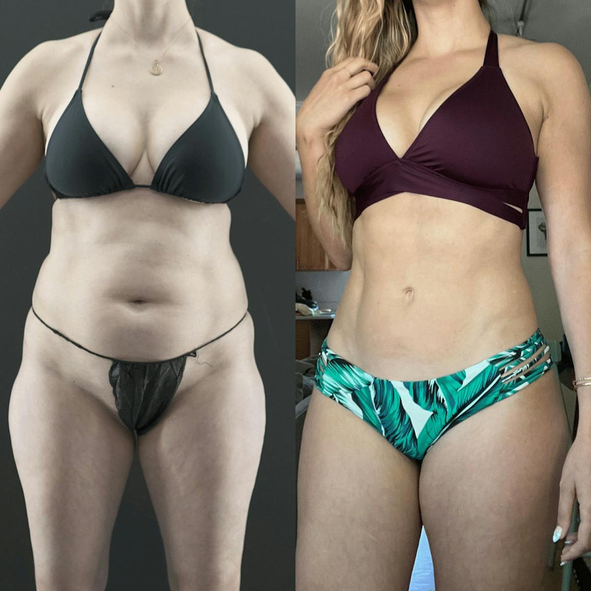 VASER/Hi-Definition Liposuction Before & After Gallery - Patient 349783 - Image 1