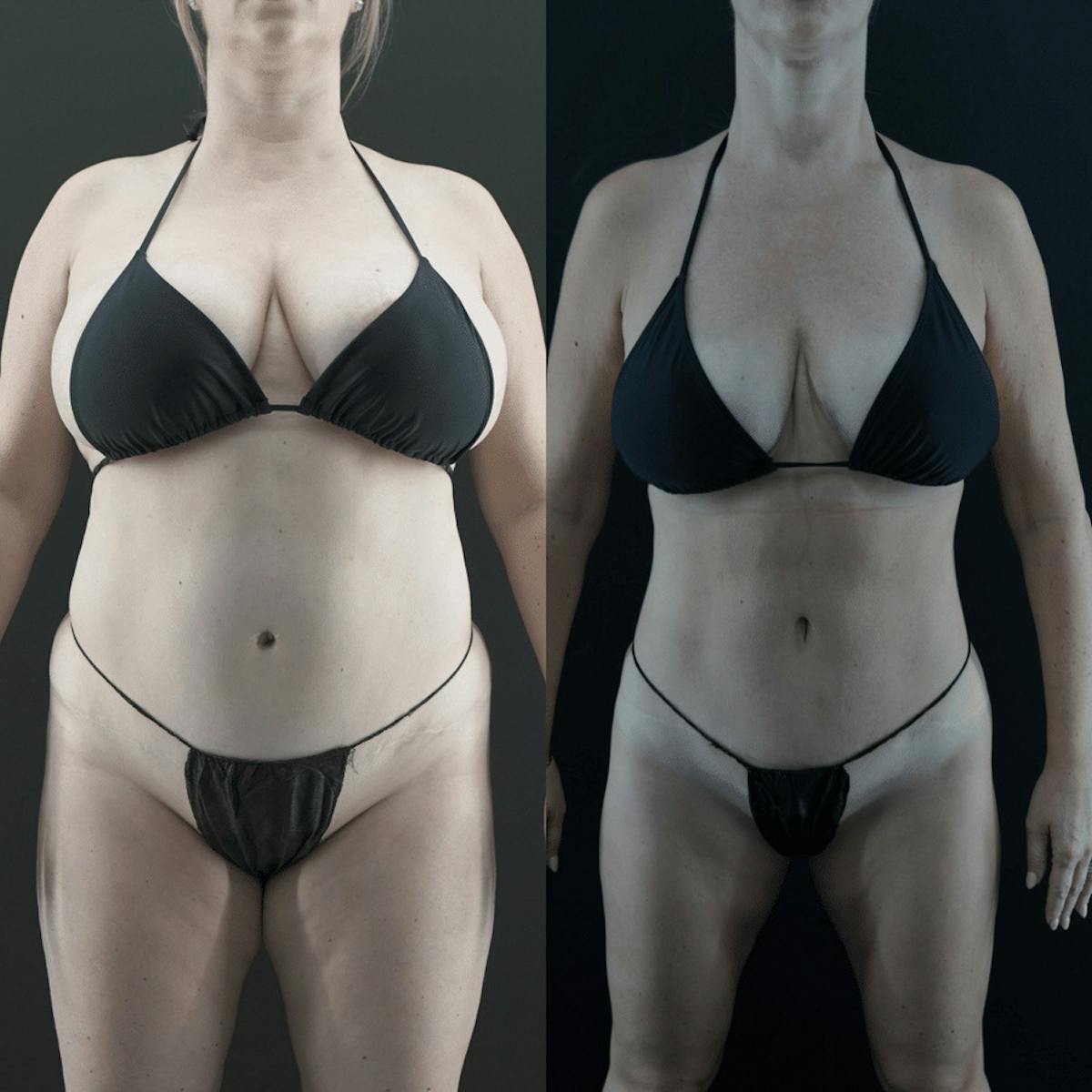 VASER/Hi-Definition Liposuction Before & After Gallery - Patient 357849 - Image 2