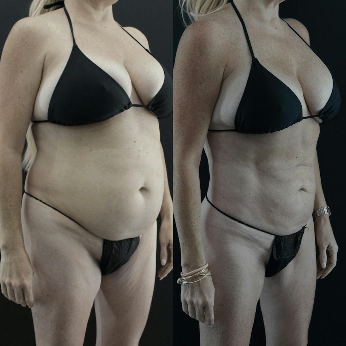 VASER/Hi-Definition Liposuction Before & After Gallery - Patient 357849 - Image 1