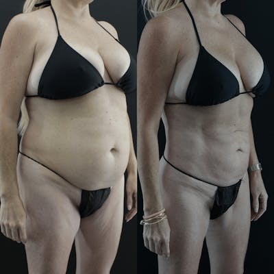VASER/Hi-Definition Liposuction Before & After Gallery - Patient 357849 - Image 1
