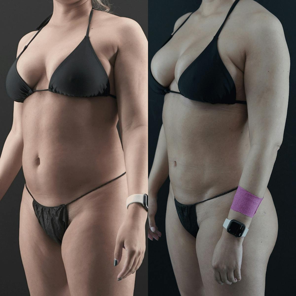 VASER/Hi-Definition Liposuction Before & After Gallery - Patient 391448 - Image 2