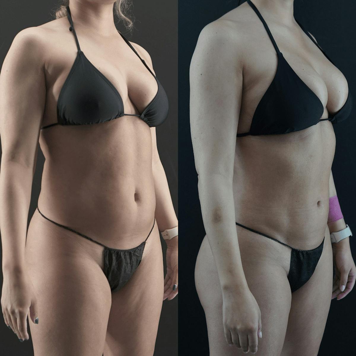VASER/Hi-Definition Liposuction Before & After Gallery - Patient 391448 - Image 3