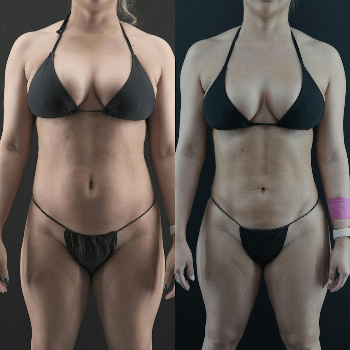 VASER/Hi-Definition Liposuction Before & After Gallery - Patient 391448 - Image 1
