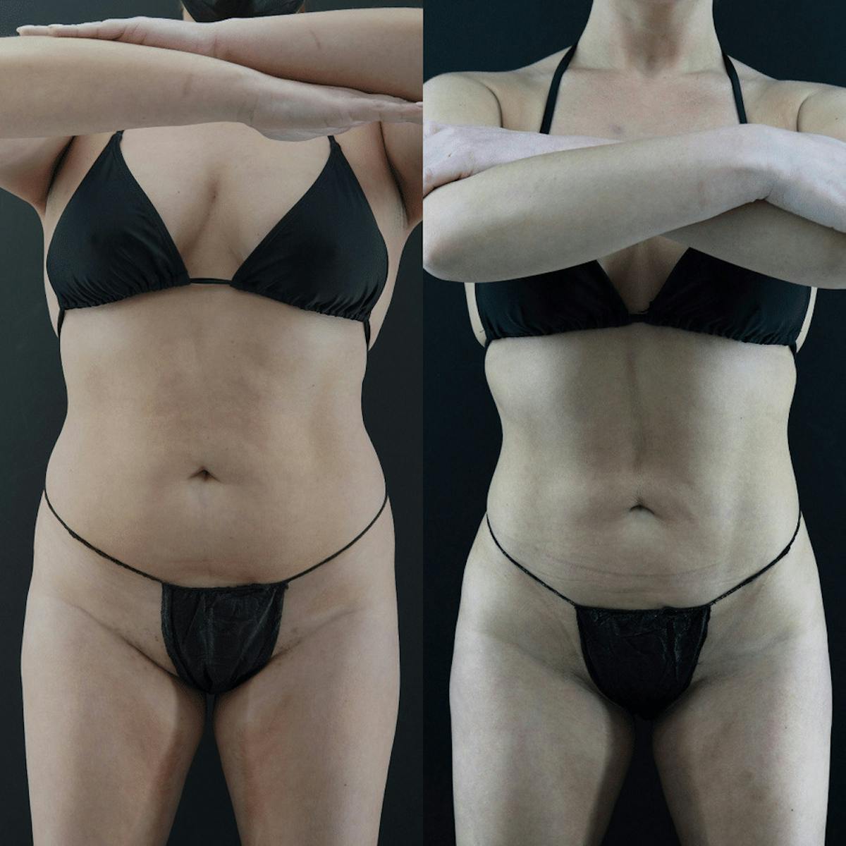 VASER/Hi-Definition Liposuction Before & After Gallery - Patient 192359 - Image 2