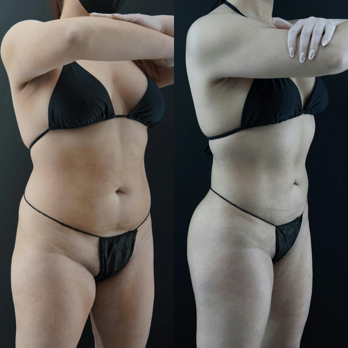 VASER/Hi-Definition Liposuction Before & After Gallery - Patient 192359 - Image 1