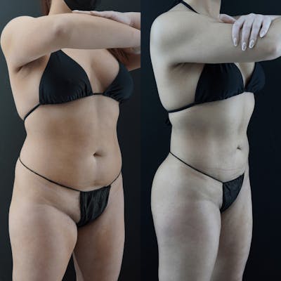 VASER/Hi-Definition Liposuction Before & After Gallery - Patient 192359 - Image 1