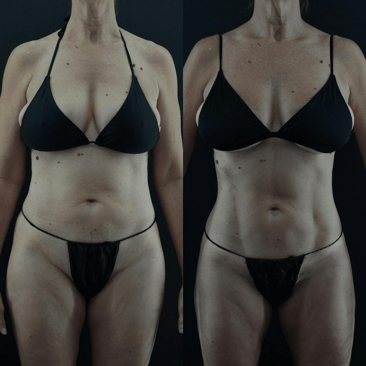 VASER/Hi-Definition Liposuction Before & After Gallery - Patient 949509 - Image 2
