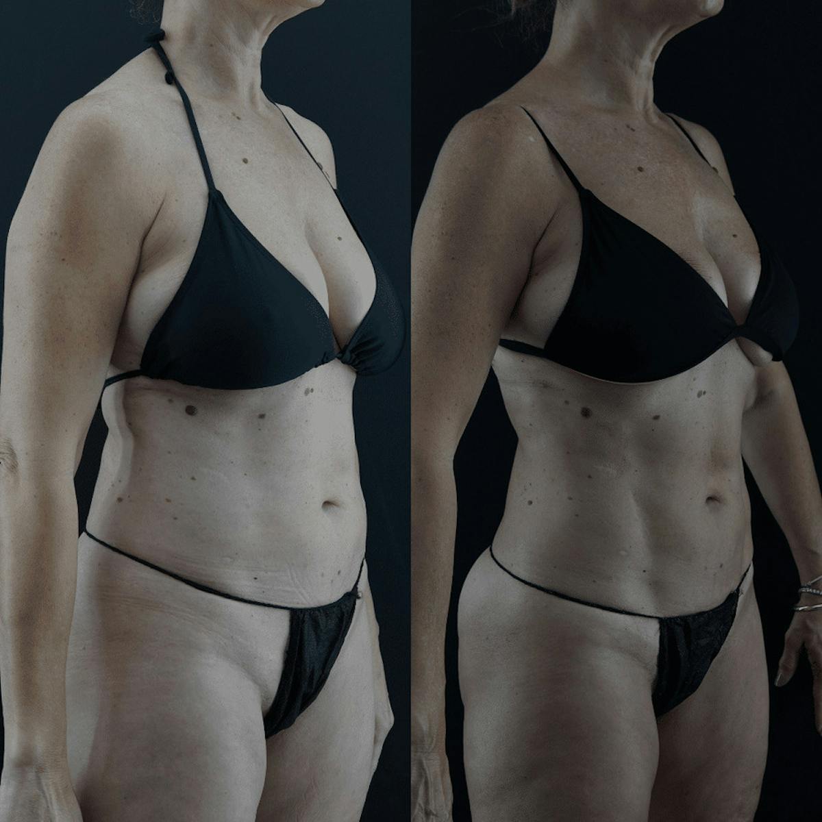 VASER/Hi-Definition Liposuction Before & After Gallery - Patient 949509 - Image 1