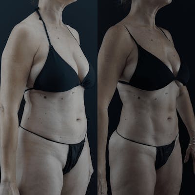 VASER/Hi-Definition Liposuction Before & After Gallery - Patient 949509 - Image 1