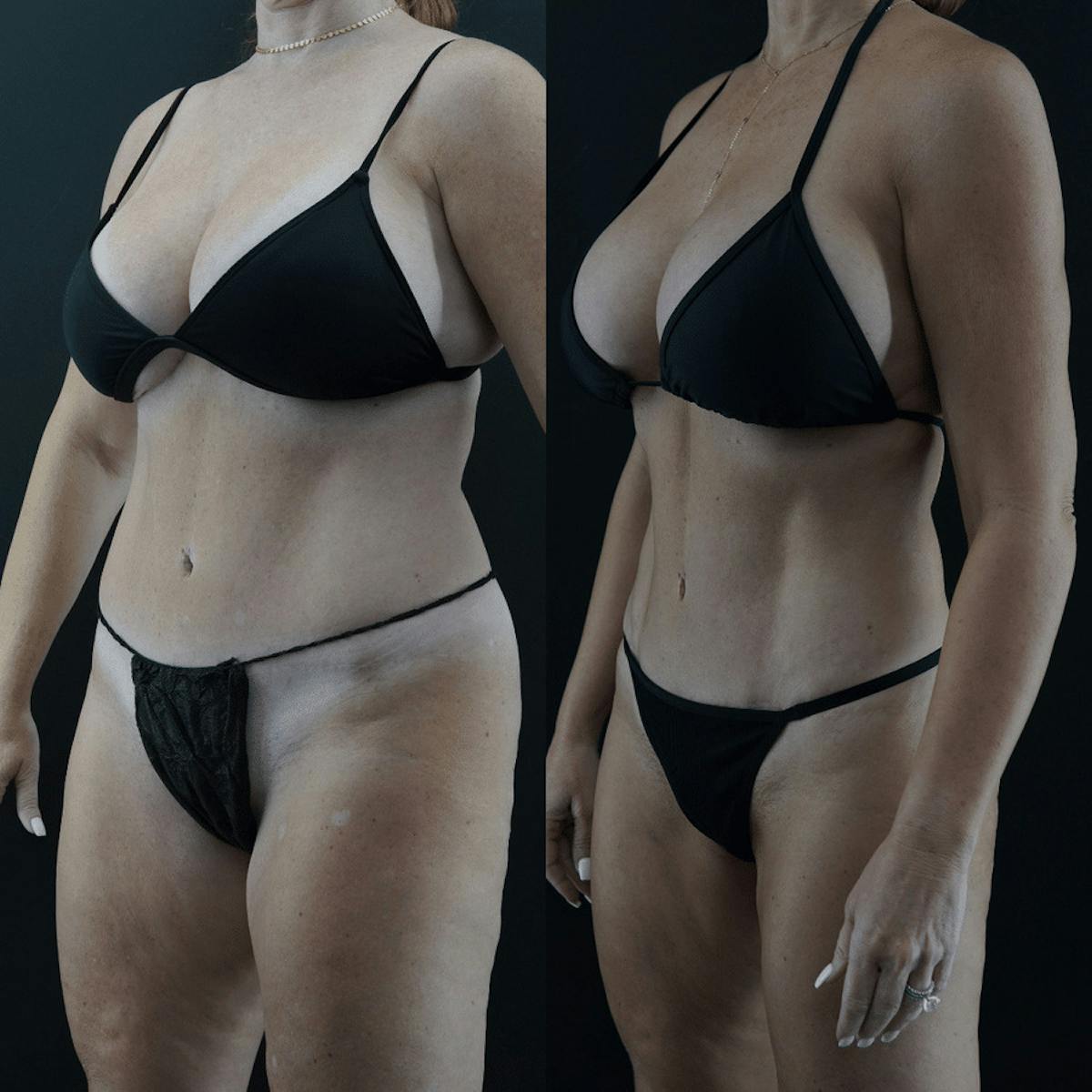 VASER/Hi-Definition Liposuction Before & After Gallery - Patient 328506 - Image 2