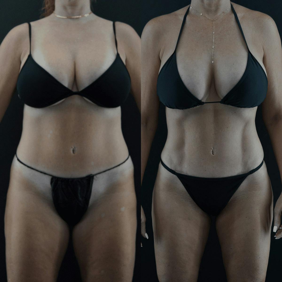 VASER/Hi-Definition Liposuction Before & After Gallery - Patient 328506 - Image 1