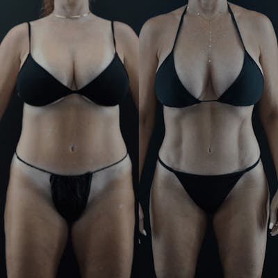 VASER/Hi-Definition Liposuction Before & After Gallery - Patient 328506 - Image 1