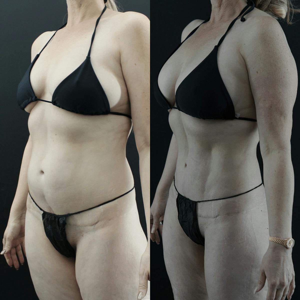 VASER/Hi-Definition Liposuction Before & After Gallery - Patient 230451 - Image 2