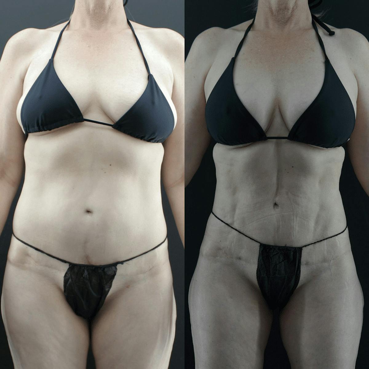VASER/Hi-Definition Liposuction Before & After Gallery - Patient 230451 - Image 3