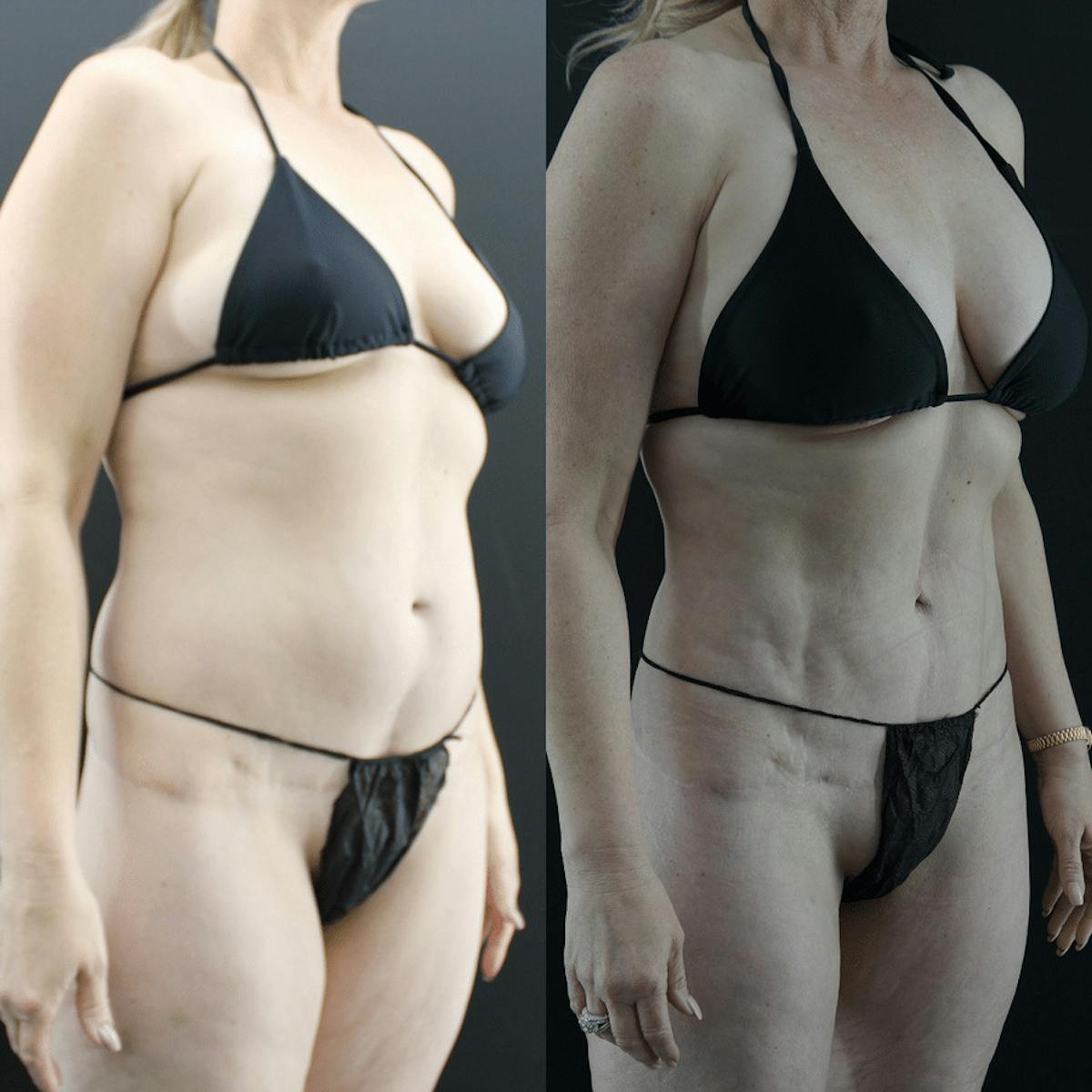 VASER/Hi-Definition Liposuction Before & After Gallery - Patient 230451 - Image 1