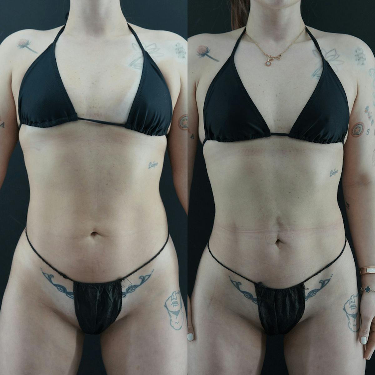 VASER/Hi-Definition Liposuction Before & After Gallery - Patient 376242 - Image 2