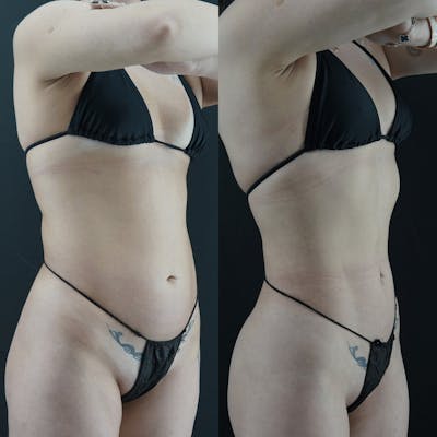 VASER/Hi-Definition Liposuction Before & After Gallery - Patient 376242 - Image 1