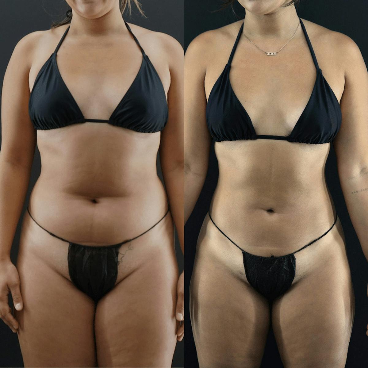 VASER/Hi-Definition Liposuction Before & After Gallery - Patient 422484 - Image 2