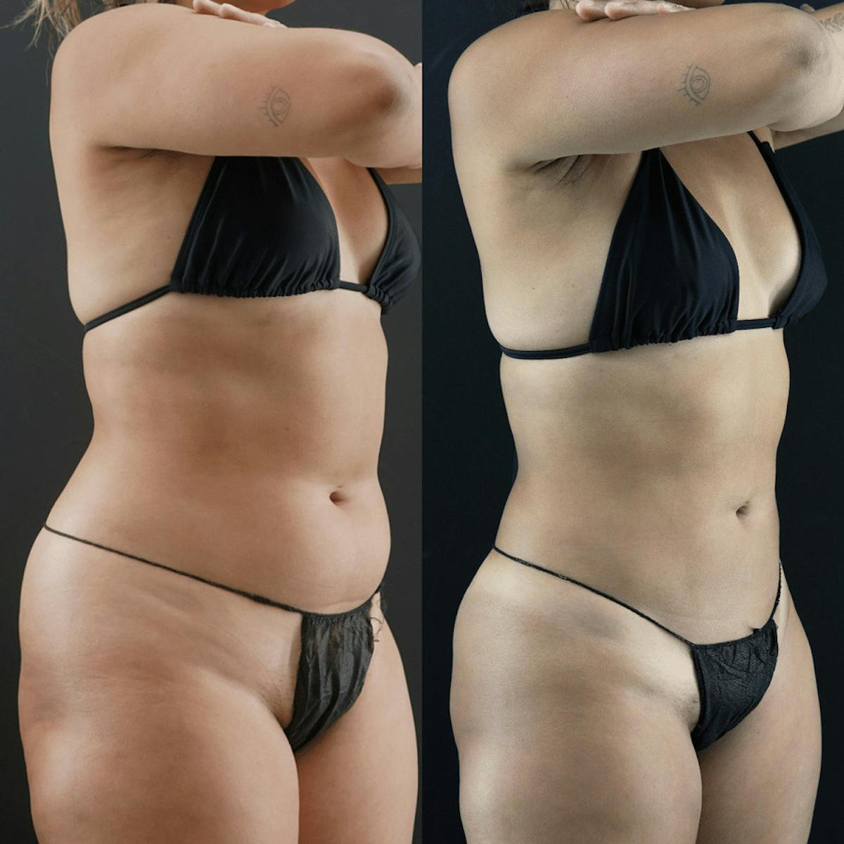 VASER/Hi-Definition Liposuction Before & After Gallery - Patient 422484 - Image 1
