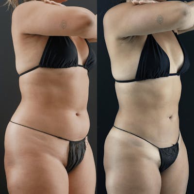 VASER/Hi-Definition Liposuction Before & After Gallery - Patient 422484 - Image 1