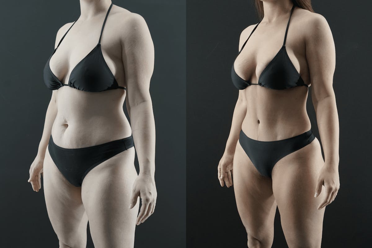Tummy Tuck Before & After Gallery - Patient 375878 - Image 2