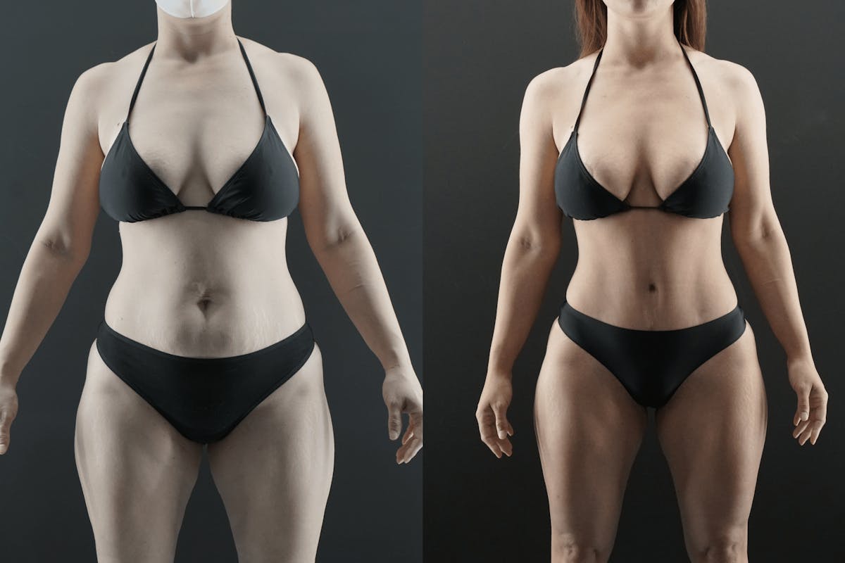 Tummy Tuck Before & After Gallery - Patient 375878 - Image 1