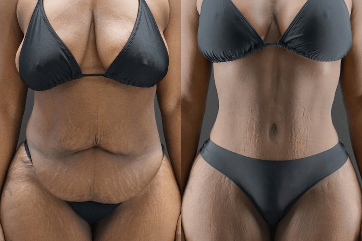 Tummy Tuck Before & After Gallery - Patient 334529 - Image 2