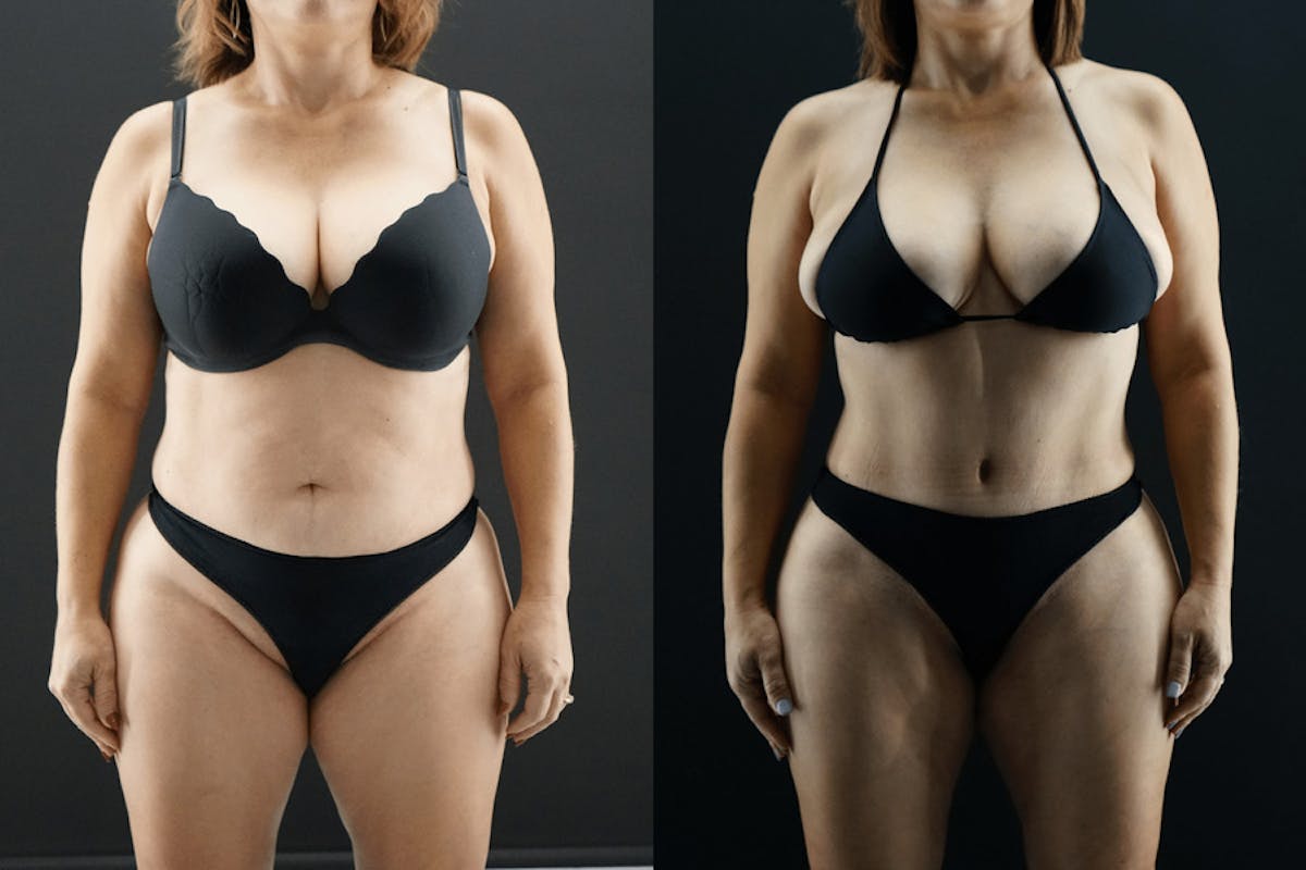 Tummy Tuck Before & After Gallery - Patient 714810 - Image 1