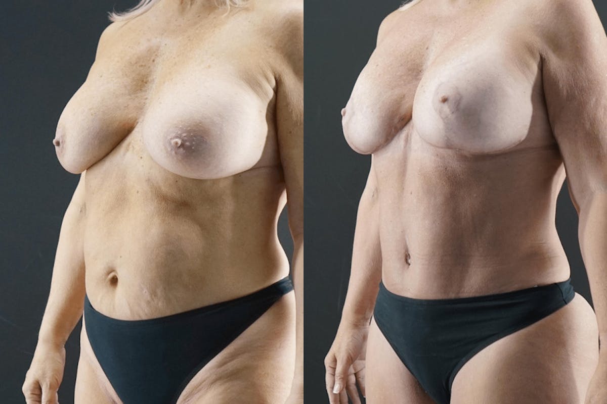 Tummy Tuck Before & After Gallery - Patient 361577 - Image 1