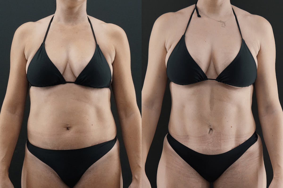 Tummy Tuck Before & After Gallery - Patient 344433 - Image 2
