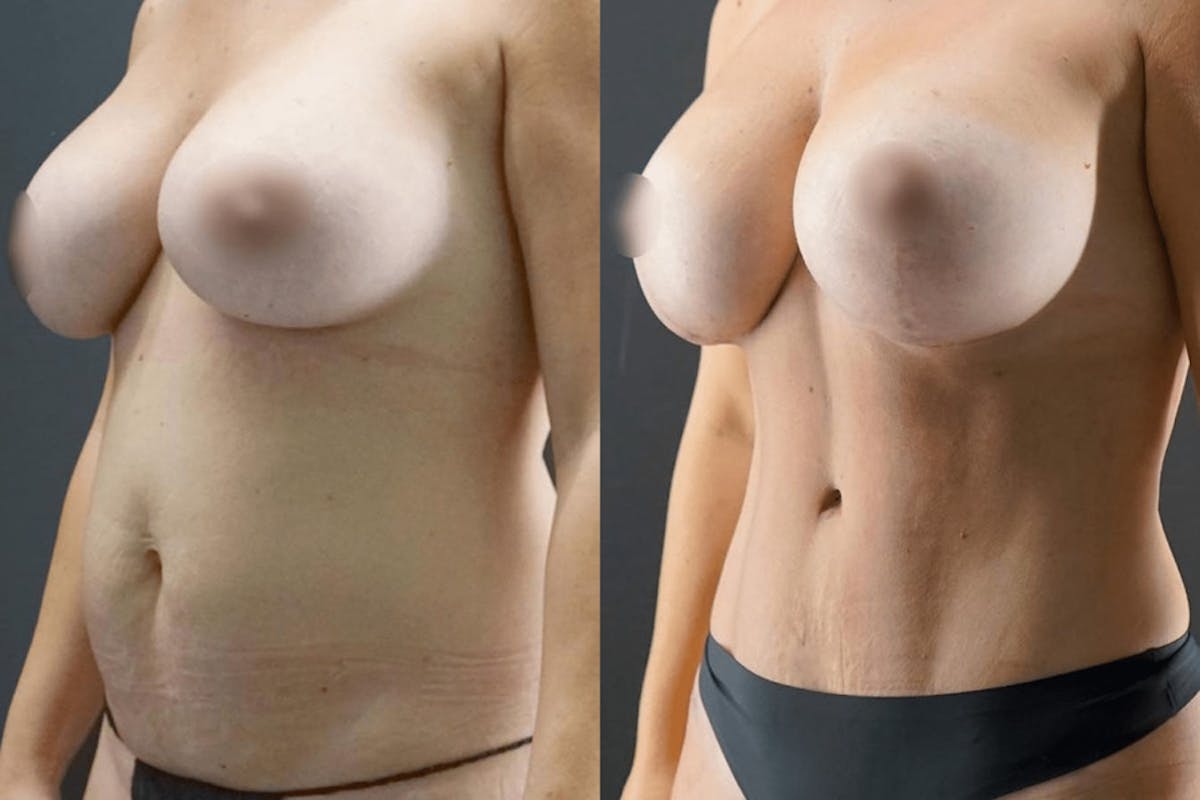 Tummy Tuck Before & After Gallery - Patient 424623 - Image 1