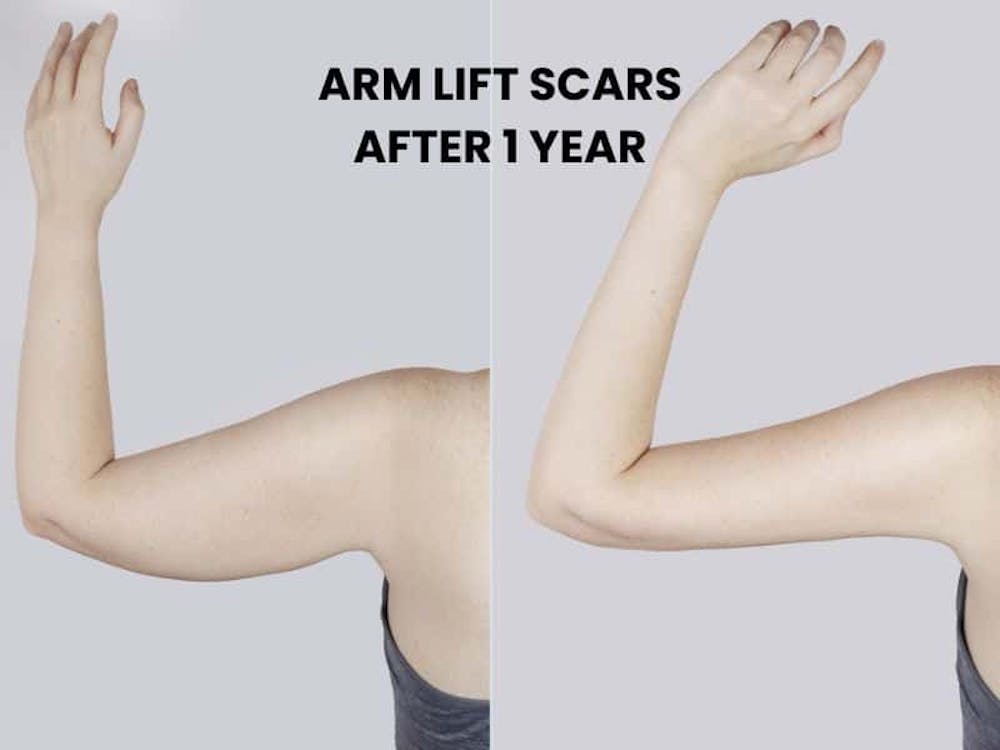 How to Minimize Arm Lift Scars | Galanis Plastic Surgery