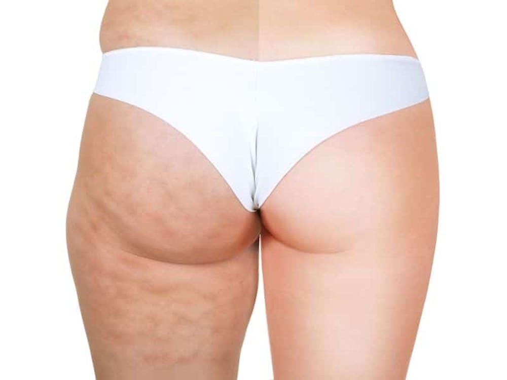 aveli before and after thighs aveli before and after thighs