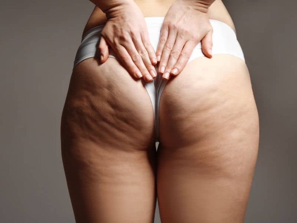 cost of aveli cellulite treatment cost of aveli cellulite treatment