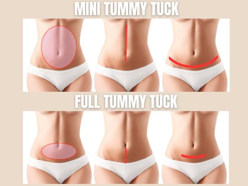 mini tummy tuck vs full mini tummy tuck vs full