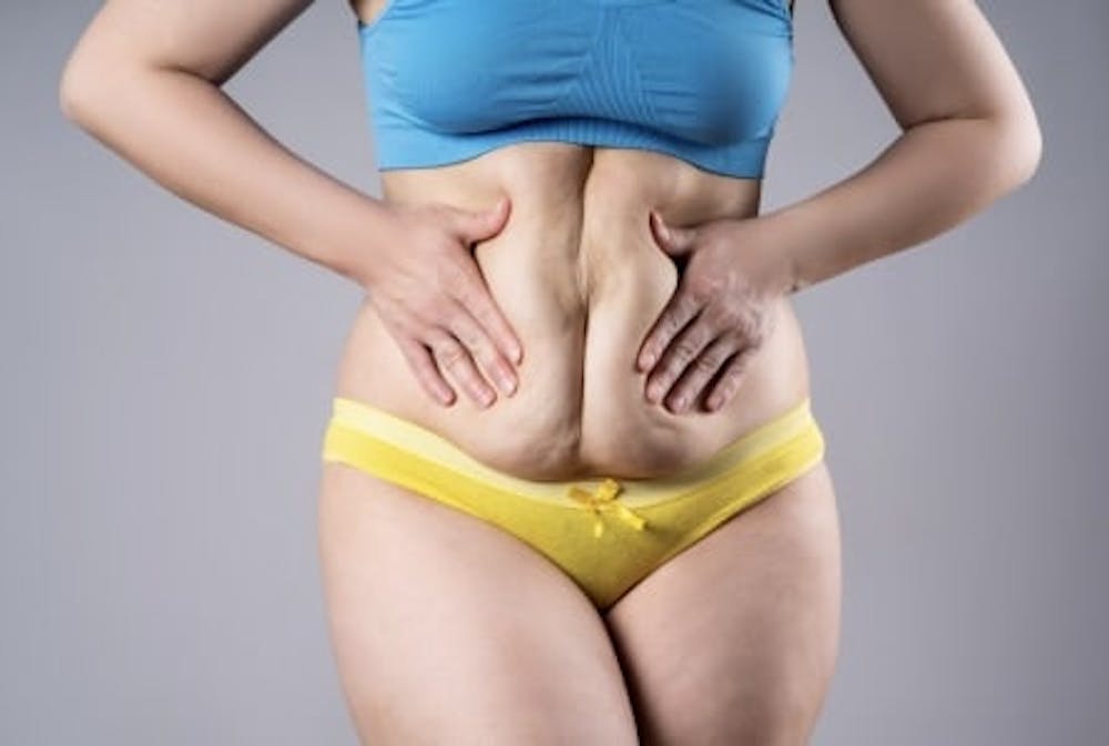 tummy tuck questions