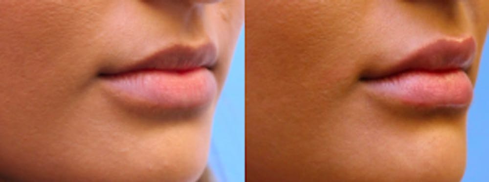 before & after photo