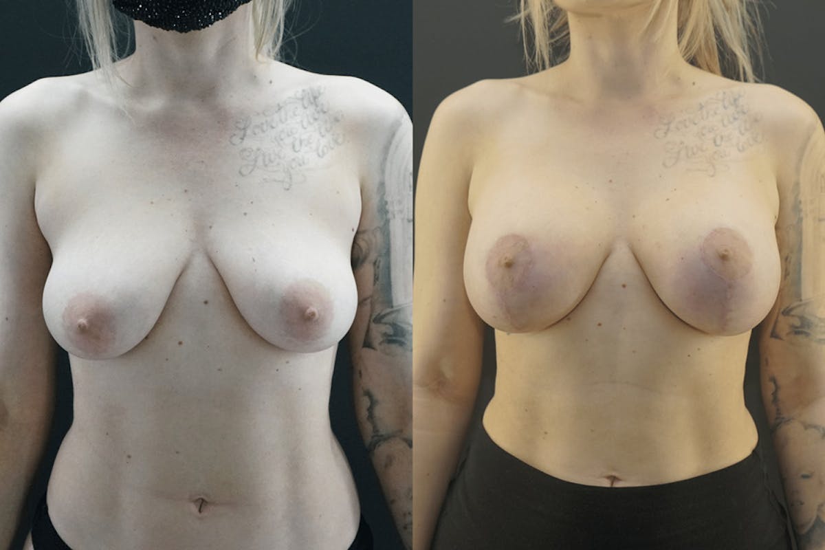 Breast Lift Before & After Gallery - Patient 394817 - Image 2