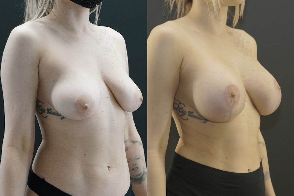 Breast Lift Before & After Gallery - Patient 394817 - Image 1