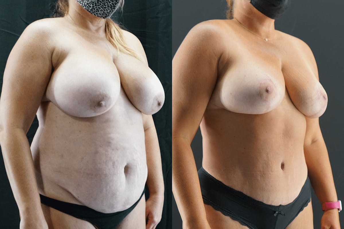 Breast Reduction Before & After Gallery - Patient 249004 - Image 1