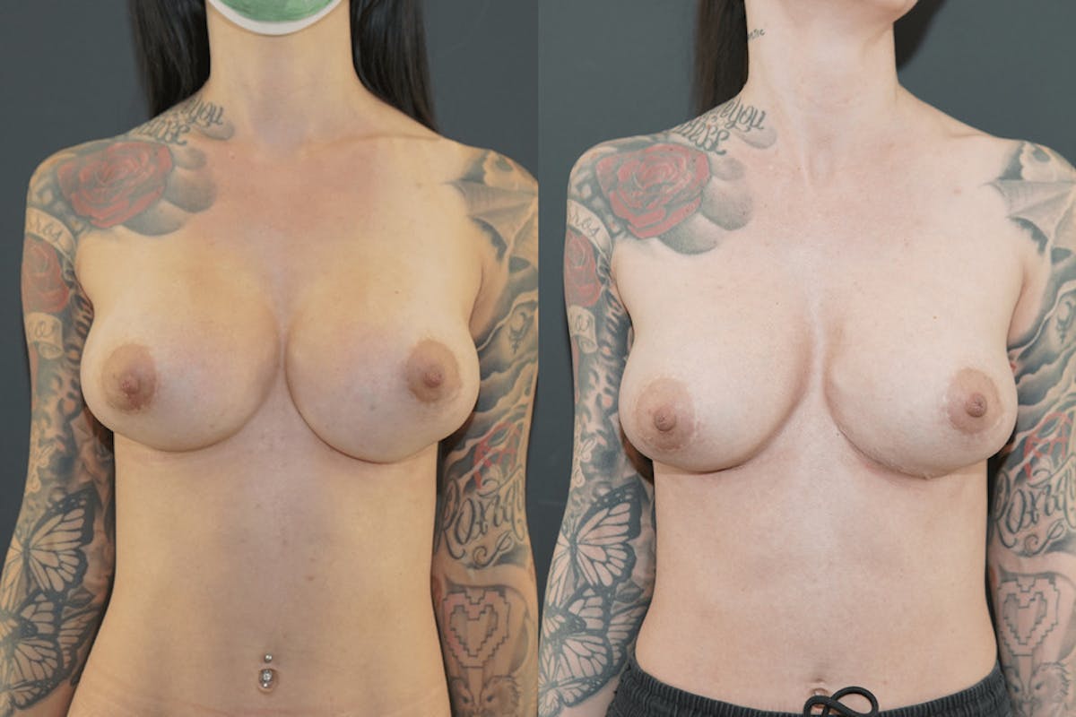 Breast Implant Revision Before & After Gallery - Patient 253067 - Image 1