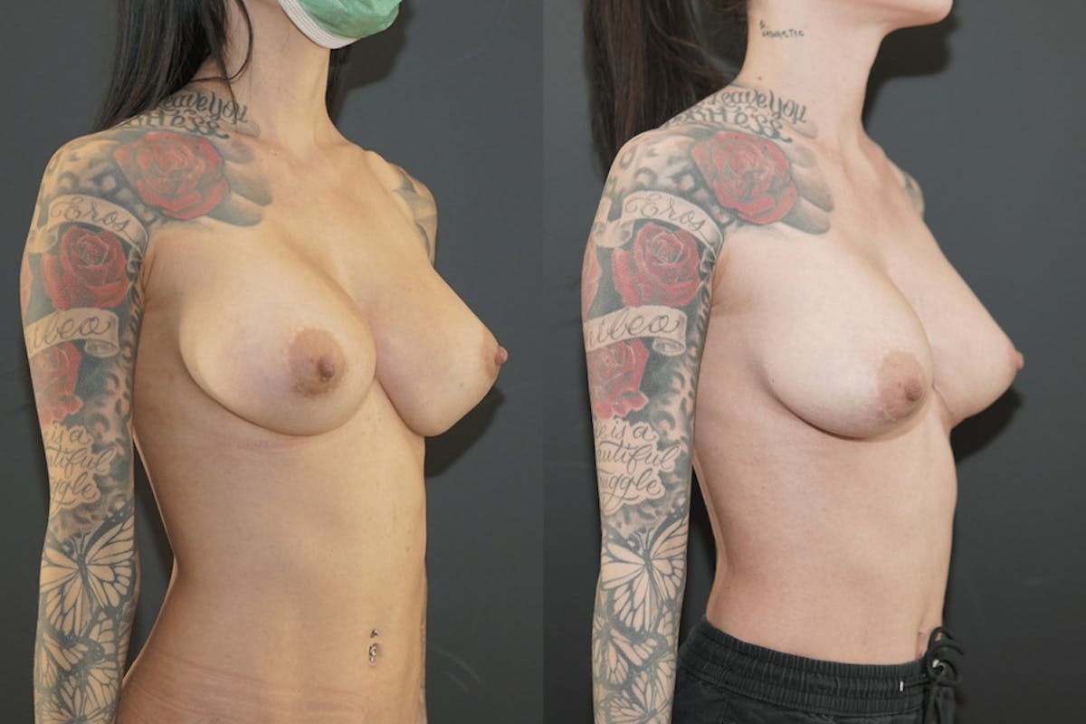Breast Implant Revision Before & After Gallery - Patient 253067 - Image 3
