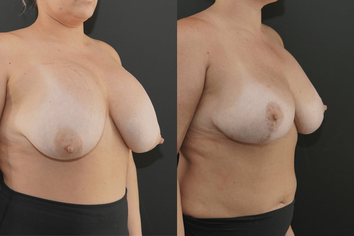 Bilateral Capsule Removal Before & After Gallery - Patient 260848 - Image 2