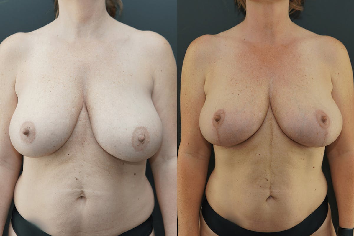 Breast Lift with No Implants Before & After Gallery - Patient 114582 - Image 2