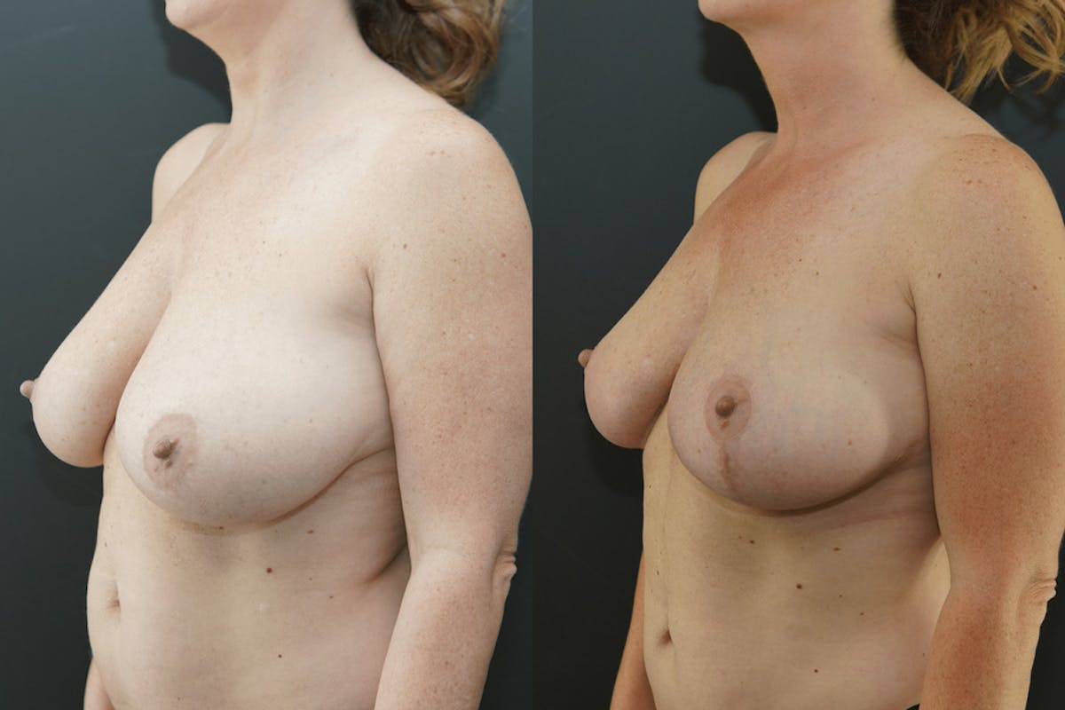 Breast Lift with No Implants Before & After Gallery - Patient 114582 - Image 1