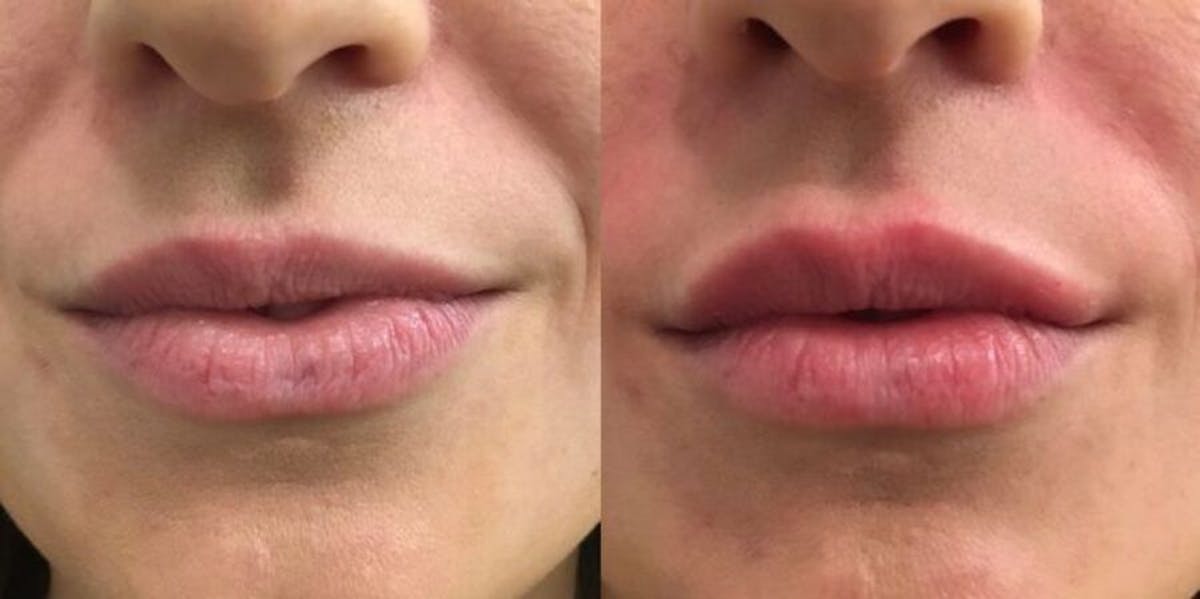 Filler Before & After Gallery - Patient 931594 - Image 1