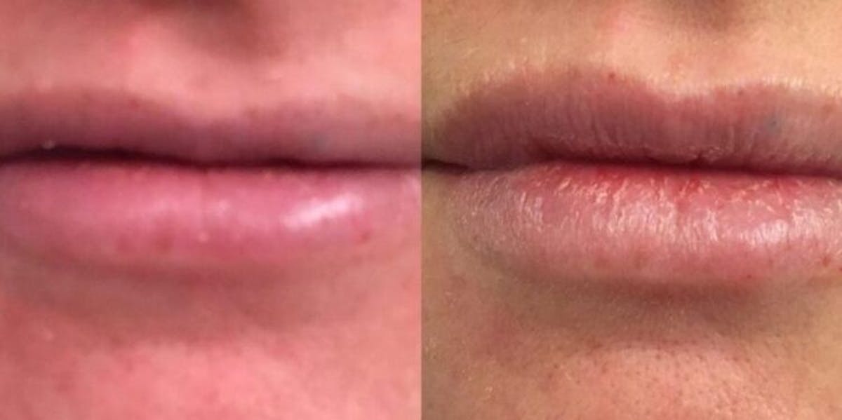 Filler Before & After Gallery - Patient 174318 - Image 1